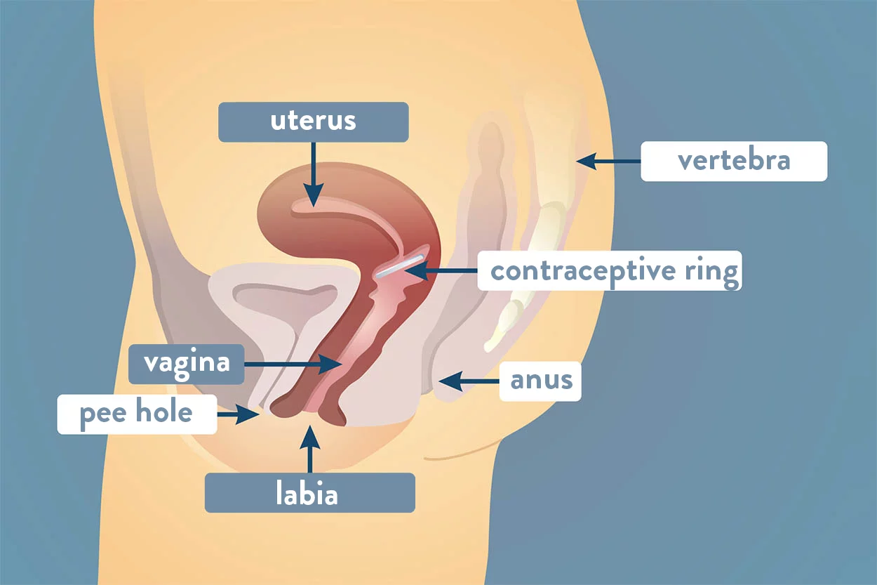 diagram: placement contraceptive ring