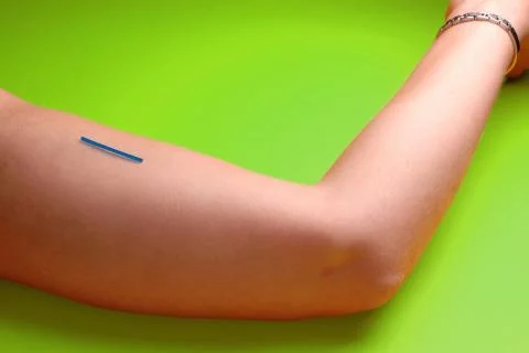 photo of a Contraceptive implant